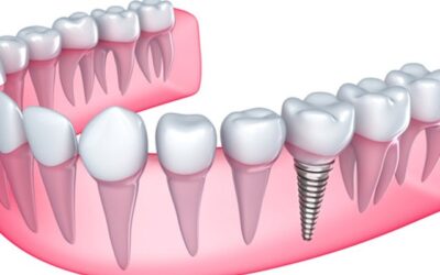 4 Benefits of Dental Implants