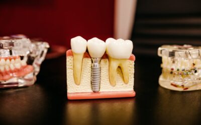 Top 5 Reasons to Consider Dental Implants