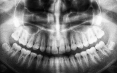 “Why should I get my wisdom teeth removed?” and Other FAQs