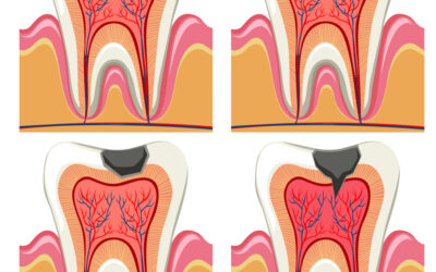 Root Canal Therapy Q&A