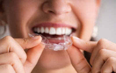 Comparison: Invisalign vs Traditional Braces