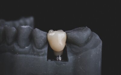 What You Should Know About Dental Implants Before Getting Them