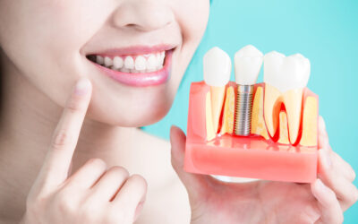 Exploring the Different Kinds of Dental Implants