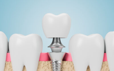 Do dental implants hurt? | A Dentist’s Guide to Minimizing Pain and Anxiety