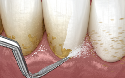 What are scaling and root planing in dentistry?