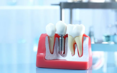 Dental Implants: Minor Surgery, Major Life Upgrade