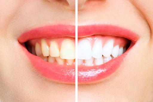 A before and after image of a person’s smile, showing tooth discoloration on the left side and whitened teeth on the right side. 