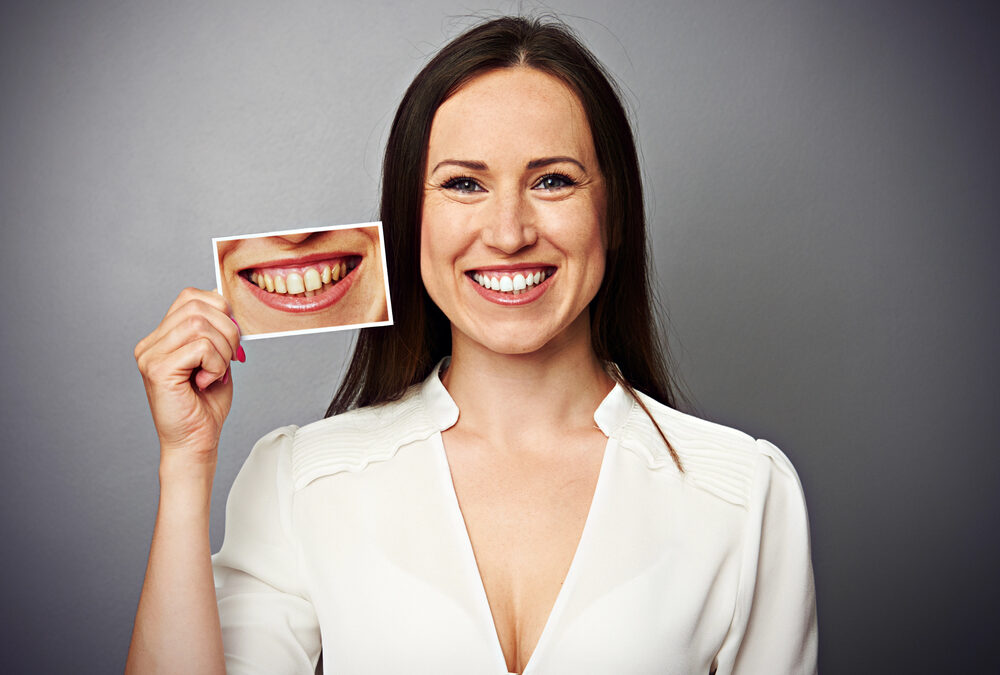 woman holding a picture of her yellow teeth before teeth whitening procedure