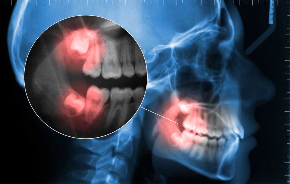 wisdom teeth highlighted on an x-ray of the human head and jaw